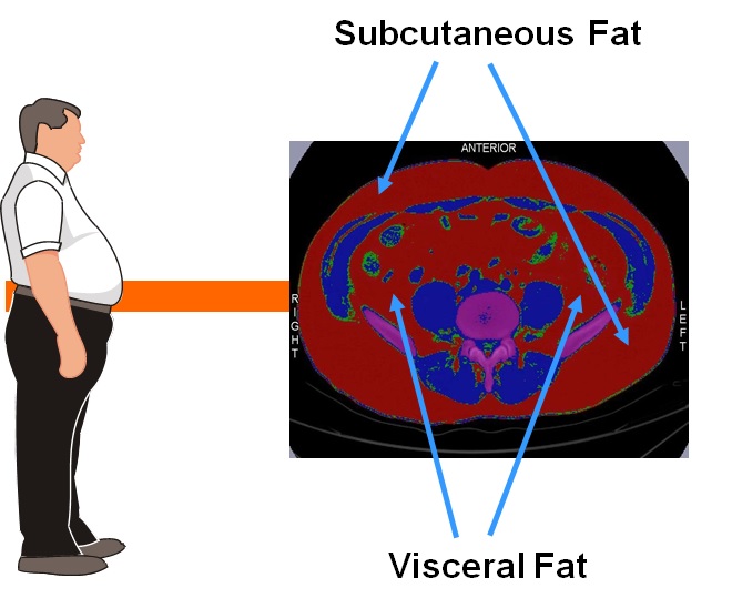 visceral fat
